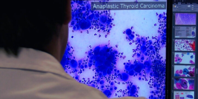 DigiPatICS. Eines d’intel·ligència artificial per millorar el diagnòstic del càncer als hospitals públics de Catalunya